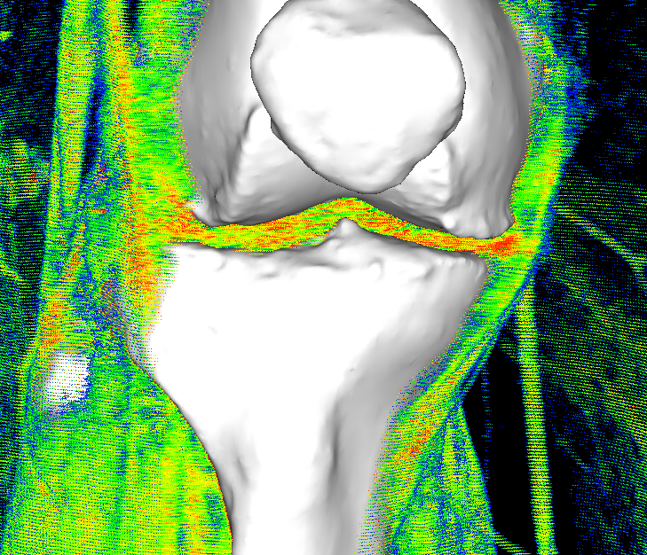 Pre-op and Post-op medical image driven Principal Density Analysis for surgical outcomes scoring